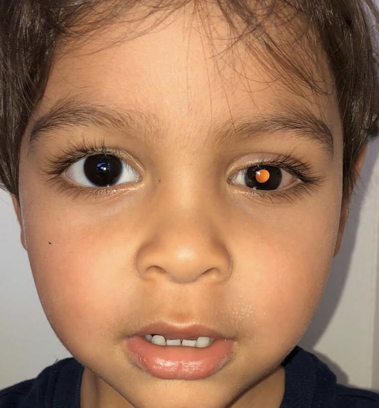 Diagnosis: Bilateral Retinoblastoma