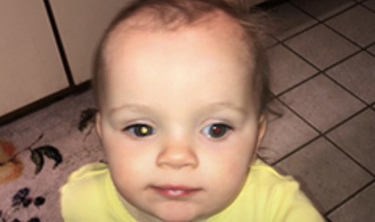 Diagnosis: Retinoblastoma